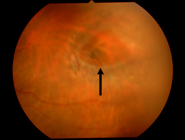 網膜剥離のイメージ（図-5）