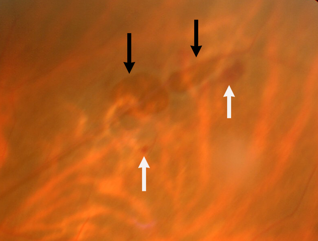 網膜剥離のイメージ（図-6）