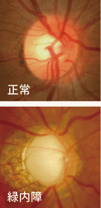 OCTによる緑内障と正常な眼の比較